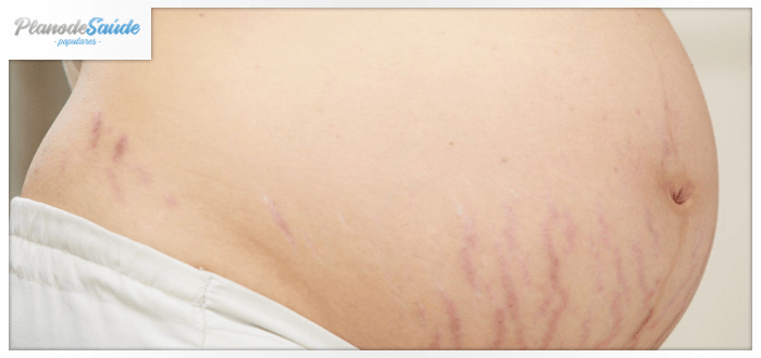 mulher grávida com estrias na barriga - gravidez